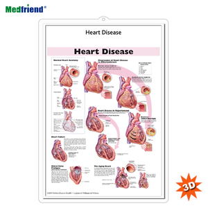 Gráfico de pared anatómico humano médico 3D/Póster-Gráfico anatómico de enfermedades cardíacas - Product Image 1