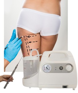 Bomba de aspiración de succión de liposucción de grado médico, bomba de infusión de 1000ML, máquina de transferencia de grasa cosmética, Láser de <span class=keywords><strong>980</strong></span> y 1470nm, endoláser - Product Image 1