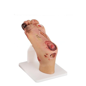 Modelo de pie diabético (leve/severo) para formación médica, educación y prevención, maniquí de pie diabético. - Product Image 2
