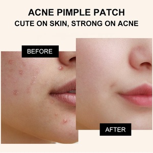 Patch anti-acné hydrocolloïde en une seule pièce, étiquette privée en vrac OEM/ODM, dessin animé, aloe vera, absorption physique, réparation, source d'usine - Product Image 3