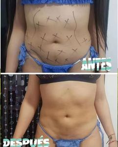 Bester Verkauf 980nm 1470nm <span class=keywords><strong>Laser</strong></span> Lipolyse <span class=keywords><strong>Laser</strong></span> gerät Fett absaugung maschine - Product Image 6