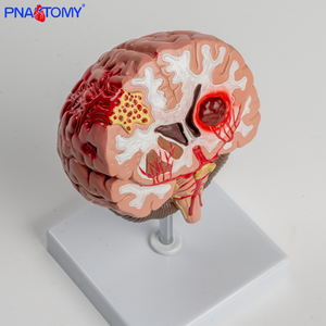 Modelo Anatômico do Cérebro PVC Hemorragia Cerebral e Malformação Arteriovenosa Patologia - Product Image 1