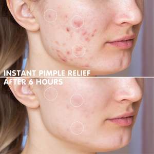 Caja de Espejo OEM con Etiqueta Privada, Parches Hidrocoloides para Acné, Parches para Granos y Manchas - Product Image 5