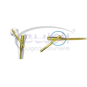 2 Pcs Supply Titanium Manual Orthopedic Implant Posterior Orthopedic PFNAF emoral Intramedullary Nail By <b>Blush</b> Surgical - Product Image 4