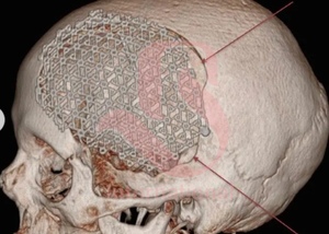 BISONS Wholesale - Maille de cranioplastie manuelle en titane pour la neurochirurgie, la reconstruction cérébrale et l'implantation crânienne - Kit complet - Product Image 6