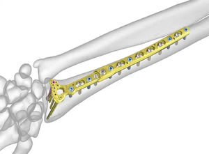 Implantes Ortopédicos de Calidad Superior para Cirugía Básica, Juego de Placas Óseas para Animales Pequeños, Instrumentos Quirúrgicos Veterinarios de Acero Inoxidable - Product Image 4