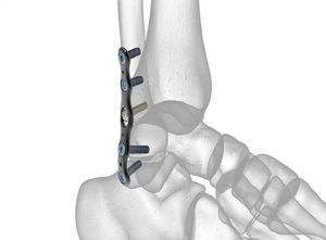 Implantes Ortopédicos de Calidad Superior para Cirugía Básica, Juego de Placas Óseas para Animales Pequeños, Instrumentos Quirúrgicos Veterinarios de Acero Inoxidable - Product Image 6