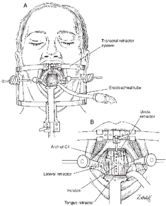 Ensemble d'instruments trans-oraliens Zetomedpro Spetzler Sonntag pour la chirurgie générale, certifié CE, ISO13485 Classe I, outils manuels - Product Image 4