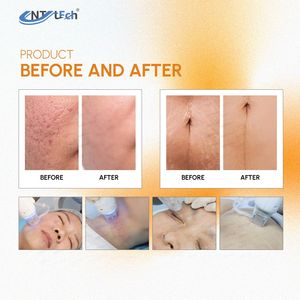 Portable Gold Rf Microneedling Cartridges Wrinkle Remover <strong>Radiofrequency</strong> RF Needle Skin Tightening Microneedle Machine - Product Image 5