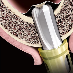 Superventas: Herramienta Quirúrgica para Levantamiento de Senos Dentales, Implante de Taladro, Elevador Hidráulico, Tubo de Agua Aqua Tip, Guía Crestal CAS - Product Image 3