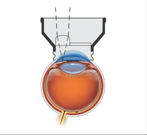 เลนส์ผ่าตัด Opticlear YAG สำหรับการผ่าตัดจมูกตา เลนส์สำหรับการวินิจฉัย เครื่องมือผ่าตัดจักษุ ประเภทที่ 2 ใช้งานด้วยมือ ได้รับการรับรองมาตรฐาน CE - Product Image 2