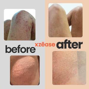 Crema para el Alivio del Eccema y la Piel con Problemas Más Vendida, Crema Hidratante y Calmante de Alta Calidad para Piel Sensible y con Picazón - Product Image 5