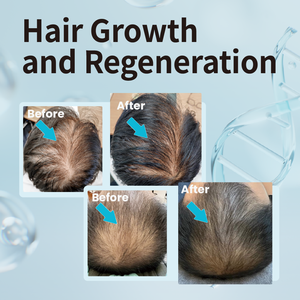 Aceite de Árbol de Té Anticaspa de Marca Privada, Hidratante, Voluminizador, Refrescante, Previene la Caída del Cabello, Nutre y Suaviza el Cabello y el Cuero Cabelludo, Lo Mejor para el Cabello - Product Image 5