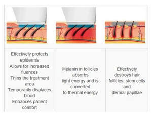 Máquina de Depilación Láser Diodo de Última Generación, 3 Longitudes de Onda 808/755/1064, Indolora - Product Image 4