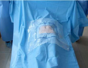 Ensemble de draps pour césarienne, jetable, à usage unique, stérile EO, pack chirurgical respirant et confortable, durée de conservation de 3 ans |   CE MDR - Product Image 1