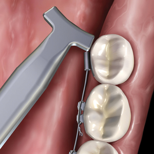 Pince à marteau lingual en NiTi, outil orthodontique professionnel, instrument dentaire sûr et efficace, de haute qualité et durable - Product Image 1