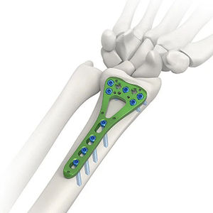 Placa de Bloqueo Volar para Radio Distal de Calidad Premium, Implante de Fijación Ósea Ortopédica de Acero Inoxidable para Trauma, de Med Innovations - Product Image 2