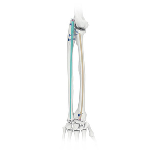 Clou intramédullaire fémoral, système de clouage fémoral proximal pour les fractures intertrochanteriques - Product Image 1