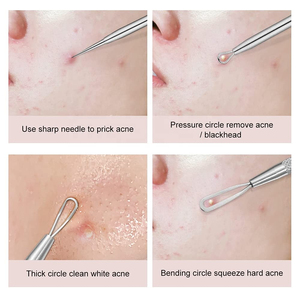 Professional Design Black & White Head Remover Customized Salon & Home Use Dual End Anti Rust Pimple Acne <b>Extractor</b> - Product Image 6