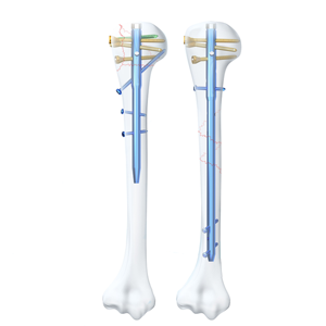Clavo Intramedular Ortopédico Multibloqueo Interconectable para Húmero, Implantes y Materiales de Intervención de Blush Surgical - Product Image 1
