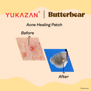 Clearance Acne Pimple Patch Yukazan Brand Hydrocolloid <b>Bear</b> <b>Cute</b> Design Breathable Waterproof Circle 20 Patches - Product Image 5