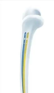 Clavo Intramedular Femoral Proximal PFNA de Acero Inoxidable Gama Nails, Manual, Alta Calidad, 1 Año de Garantía, Instrumentos - Product Image 4