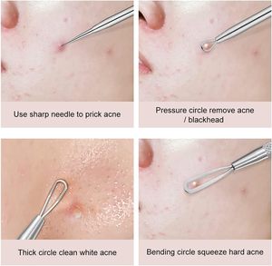 11cm High Carbon Steel Face Comedone <b>Extractor</b> <b>Tool</b> | Professional Double-Ended Acne & <b>Blackhead</b> Remover - Product Image 6