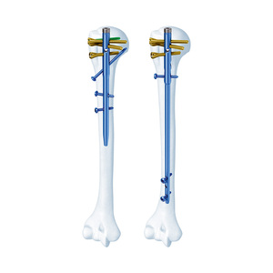 Clavo Intramedular de Titanio de Grado Médico con Certificación CE Geasure, Clase III, 1 Año de Garantía para Fijación Interna <span class=keywords><strong>Proximal</strong></span> - Product Image 1