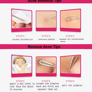 Outil professionnel de suppression des points noirs, outil de qualité supérieure en acier inoxydable, aiguilles pour éliminer les comédons, l'acné et les boutons - Product Image 3