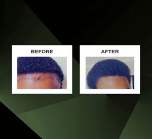 อาหารบำรุงเส้นผมโชฮัน สำหรับผมชาวแอฟริกัน ด้วยน้ำมันทีทรี - Product Image 2