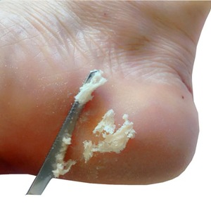 Kit d'outils de manucure et pédicure, rasoir à ongles d'orteils, couteau de pédicure, lime à callosités, éliminateur de peaux mortes, outils de soin des pieds - Product Image 6