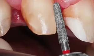 Fraise à diamant Mani de haute qualité pour une préparation dentaire rapide, précise et sûre en clinique, disponible au meilleur prix - Product Image 2