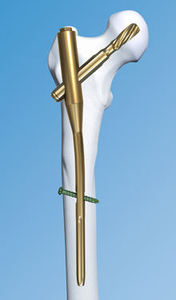 Forceps orthopédiques postérieurs en acier inoxydable de haute qualité, réutilisables, certifiés C-Tick, à stérilisation manuelle à haute température - Product Image 5