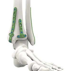 Placa de bloqueo volar para radio distal con certificación CE para el tratamiento de fracturas agudas instables, implante de fijación ósea de acero para traumatología ortopédica - Product Image 3