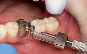 ที่ยึดวงแหวนฟันแบบเมทริกซ์ ทอฟเฟลมีร์ - Product Image 5