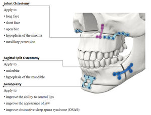 Plaque de pont maxillo-faciale droite mini de 1,0 mm d'épaisseur, plaque médicale, implant osseux à tête de vis de 2,0 mm, CE Narham Enterprises - Product Image 6