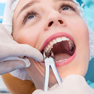 Pinzas de Extracción Dental de Acero Inoxidable de Alta Calidad para Venta en Línea - Product Image 2