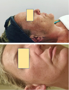 ไพร์มผิวลอกออกกรด30% ของเหลวต่อต้านริ้วรอยเปลือกสำหรับร่างกายใบหน้าจุดด่างดำขาวจุดด่างดำผลิตภัณฑ์สำหรับผิว - Product Image 4