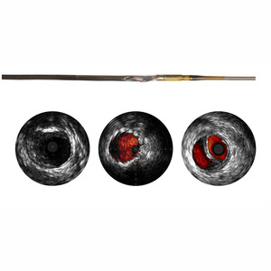 Catéter Avanzado de Grado Industrial VOLCANO VISIONS PV .014P RX Digital IVUS de 150 cm para Procedimientos de Imagenología de Arterias Periféricas - Product Image 5