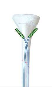 Proveedor de Tapones Elásticos de Titanio de Alta Calidad de 1.5/2.0/2.5/3.0/3.5/4.0 mm para Uñas, Marca Surgiright Instrument - Product Image 4