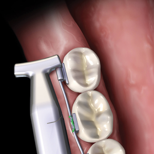 Pince à marteau fin en NiTi, outil orthodontique professionnel, instrument dentaire sûr et efficace, de haute qualité et durable - Product Image 1