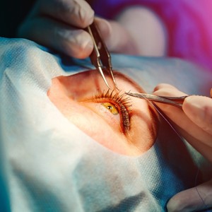 Pinzas Quirúrgicas Oftálmicas Ultrafinas de Acero Inoxidable, Microfórceps para Procedimientos de Lente de Córnea y Retina - Product Image 5