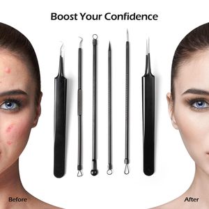 Kit de Herramientas para Eliminar Puntos Negros, Extractor de Puntos Negros de Calidad Profesional, Kit de Herramientas para Eliminar Espinillas para Nariz, Rostro, Piel, Imperfecciones Extra - Product Image 6