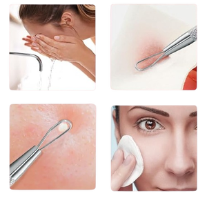 เครื่องมือกำจัดสิวเสี้ยนและสิวอุดตันคุณภาพสูงระดับมืออาชีพ ทำจากสแตนเลสสตีล - Product Image 5