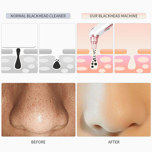 Electric Blackhead Remover <b>Vacuum</b> Facial Pore Cleaner Deep Cleansing Skin Care Device for Removing Dirt Oil and Dead Skin - Product Image 4