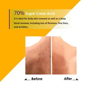 Sérum correcteur de taches brunes profondes à 70% d'acide de canne à sucre A.H.A, gel exfoliant anti-âge pour le visage et le corps, éclaircissant - Product Image 2