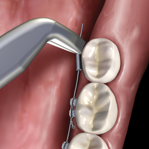 Cortador Lingual Distal, Instrumento Dental de Ortodoncia, Acero Inoxidable, Alicates de Corte de Alambre de Precisión, Uso Profesional - Product Image 1