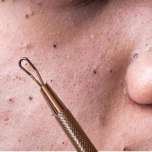 Extracteur de Comédons UBI en Acier à Haute Teneur en Carbone, Double Extrémité, Boucle d'Extraction de Précision pour Points Noirs et Points Blancs - Product Image 3