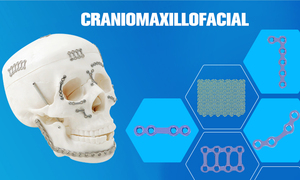 Conjunto de Instrumentos Ortopédicos para Cirugía, Certificación CE ISO, Conjunto de Instrumentos Maxilofaciales, Equipo Médico - Product Image 4