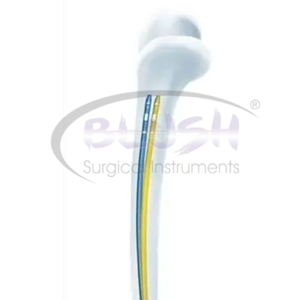 2 Pcs Supply Titanium Manual Orthopedic Implant Posterior Orthopedic PFNAF emoral Intramedullary Nail By <b>Blush</b> Surgical - Product Image 2